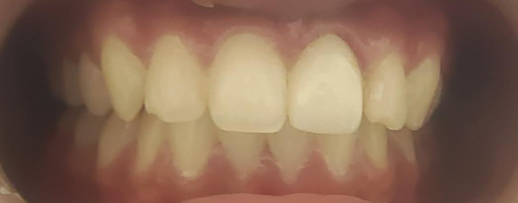 10. Cosmetic Smile Designing & Porcelain Veneers - After