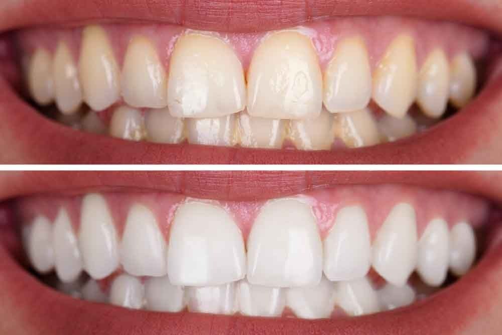 11. Advanced In-Office Teeth Whitening