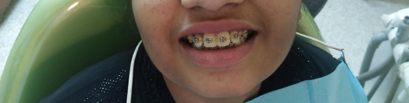 12. Clear Aligners & Invisible Orthodontics - After