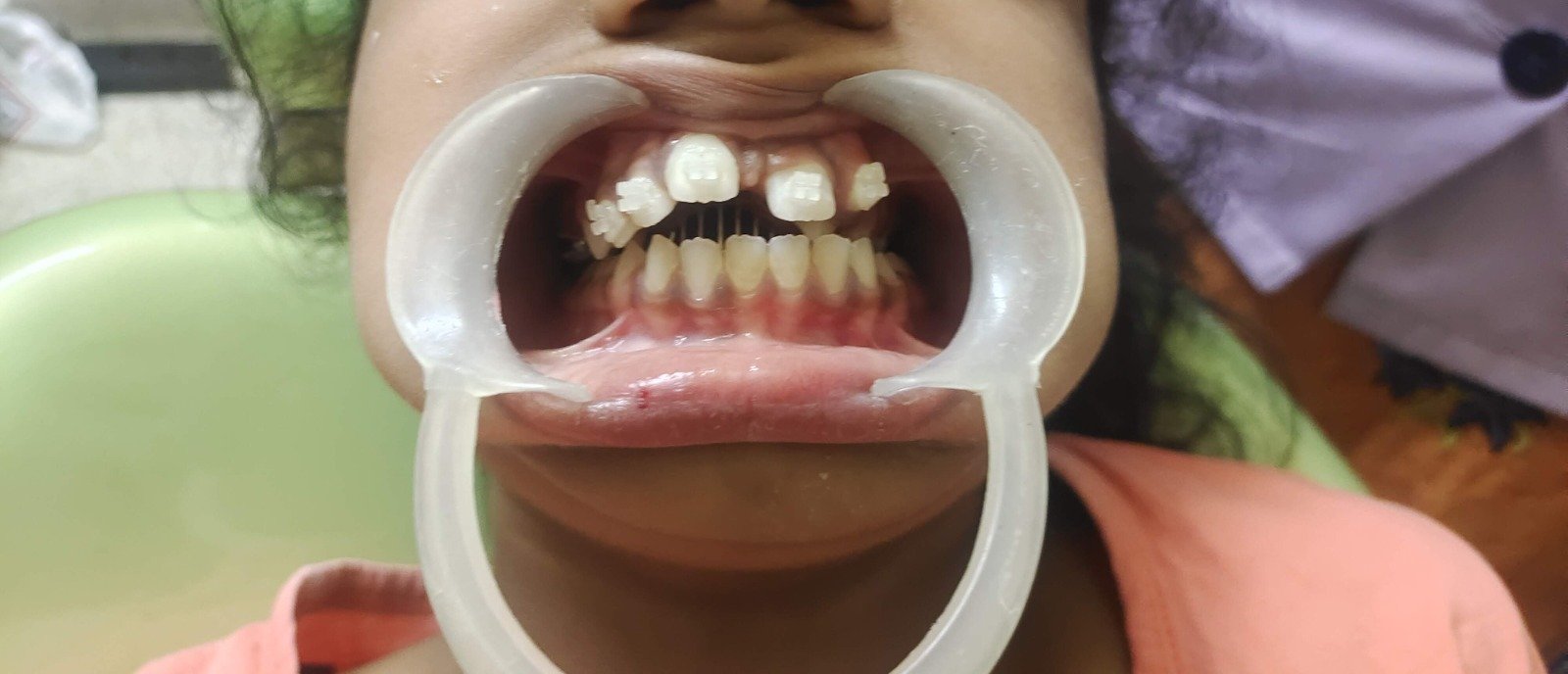 16. Oral & Maxillofacial Day-Care Surgery - Before