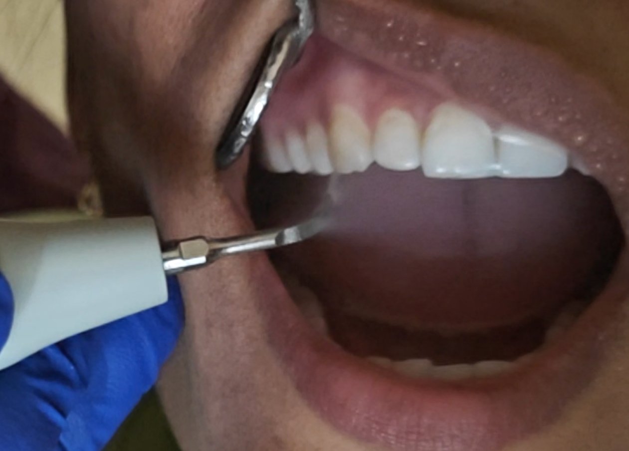 4. Teeth Cleaning & Ultrasonic Scaling