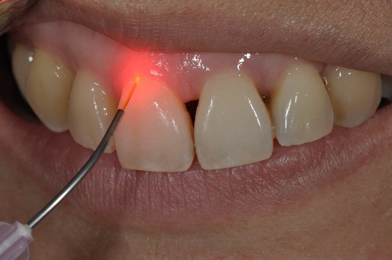 6. Root Canal Treatment (RCT) & Laser Dentistry
