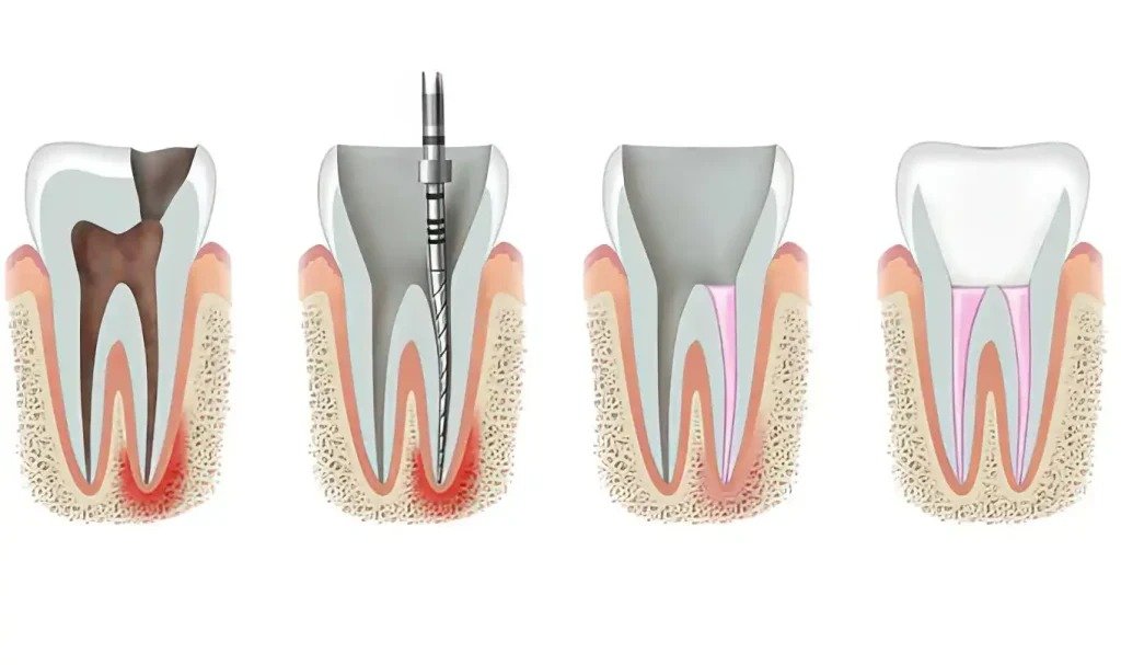 6. Root Canal Treatment (RCT) & Laser Dentistry - After
