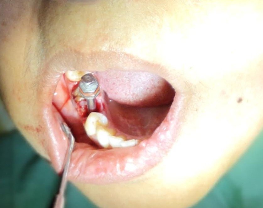 8. Advanced Dental Implants & Fixed Teeth - After